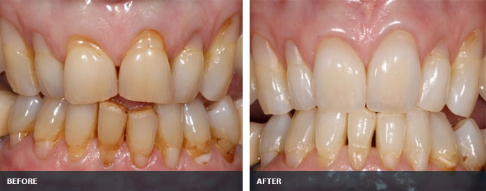 Marcus Gambroudes Same Day Teeth Case Study